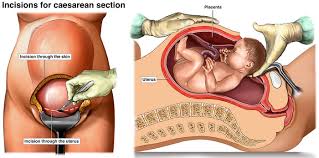 Caesarean Pregnancy Birth And Baby
