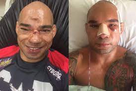 Two Years After Career Ending Injury Cyborg Won T Return To Mma Mma Fighting Michael 'venom' page is the british professional mma fighter, entrepreneur, and flagship star of bellator. two years after career ending injury