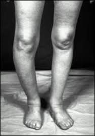 Paget's Disease of Bone - Endotext - NCBI Bookshelf