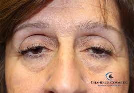 identifying and correcting ptosis droopy eyelids