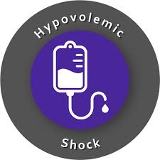 Hypovolemic shock | ACLS-Algorithms.com