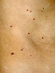 Angioma On The Skin Red Moles On The Body Many Birthmarks Stock Photo Picture And Royalty Free Image Image 92816151