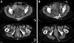 Image result for Ischiorectal Abscess