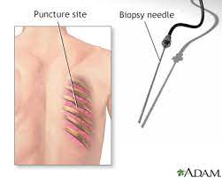 Lung Needle Biopsy Information Mount Sinai New York