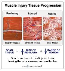 Ways to cure muscle strain at home. Hamstring Injury Information And Treatments
