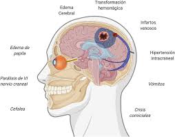 Cerebral venous thrombosis and portal vein thrombosis: Sintomas Y Eventos Fisiopatogenicos Implicados En La Trombosis De Senos Download Scientific Diagram