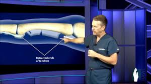 Flexor tendon injuries still remain a challenging condition to manage to ensure optimal outcome for the patient. Flexor Tendon Injuries Physiopedia