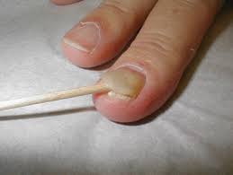 Medicul compară imaginile și rezultatele studiilor de laborator ale fiecărei etape. Probleme Ale Unghiilor La Copil Probleme Cu Unghiile La Copii