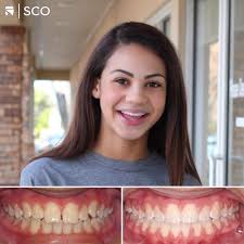 Maybe you would like to learn more about one of these? Before Afters Saddle Creek Orthodontics Germantown Braces