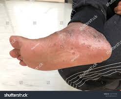 Image result for brown patches on the feet