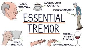 Image result for Essential Tremor