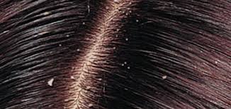 Dandruff is a common scalp condition in which small pieces of dry skin flake off of the scalp. Treating Dandruff And Itching In Dry Hair Saudi 24 News