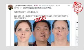 Bell's palsy is linked to latent viruses like chickenpox. Old Photos Shared As Covid 19 Vaccine Volunteers Developing Paralysis