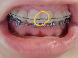 We did not find results for: What Is The Difference Between A Circle Wire And A Square Wire Braces