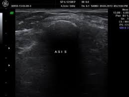 Check spelling or type a new query. Ultrasound Guided Lateral Femoral Cutaneous Nerve Block In Meralgia Paresthesia Review Of 25 Cases Sciencedirect