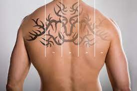 Editors | apr 27, 2018. Is Laser Tattoo Removal Painful Find Out At Geelong Veins Skin Laser