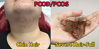 Learn how to identify which hormones lead to hair loss and how to reverse it in this guide. 5 Best Treatments For Hair Loss Due To Pcos Makeupandbeauty Com