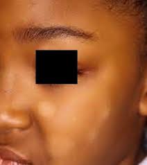 The name refers to its appearance: What Is Pityriasis Alba Gelan Health Control Center Facebook
