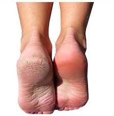 Buy Baby Foot Peeling For Ideal Foot Skin Online From Japan Japan Health Center