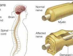 Check spelling or type a new query. Guillain Barre Syndrome Rmi