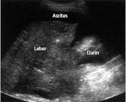 Eitriger oder blutiger ausfluss aus dem gehörgang, wenn das trommelfell geplatzt ist. Aszites Lebererkrankung Oder Karzinom Klinik Via Medici