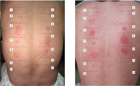 Image result for Patch Testing