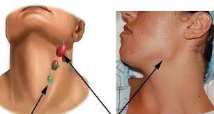 Maybe you would like to learn more about one of these? Lymfaticka Uzlina Pod CeÄ¾ustou Je Zapalena Priciny Zvacsenia Submandibularnych Lymfatickych Uzlin Co Robit A Ako Liecit