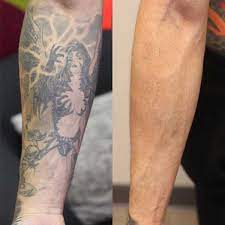 It can represent the darker side of life and also the better side depending on personal preference. Full And Half Sleeve Tattoo Removal Removery