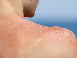 Image result for Sunburn