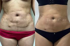 La fibrosis post liposuccion si tiene solución ✓ ( CAMBIO EN 1 SESIÓN) Px con 3 semanas post lipoescultura. 🔅La fibrosis post quirúrgica posterior a una cirugía plástica, es el acumulado de