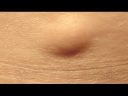 Une « boule » perçue sous la peau c'est souvent un ganglion lymphatique. Lipome Youtube