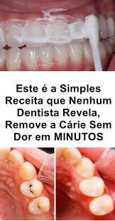 Como Eliminar As Caries Sem Ir Ao Dentista Em Minutos Passo A Passo Teeth Health Natural Remedies Health Natural Health Remedies