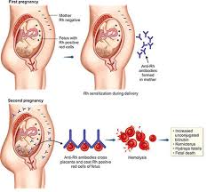 Image result for Rh Sensitization