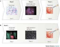 Bevacizumab is a targeted agent currently used to treat advanced cervical cancer. Current And Future Cervical Screening Techniques A Currently Download Scientific Diagram