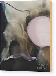 Image result for Voiding Cystourethrogram