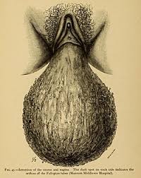 Image result for Uterine Inversion