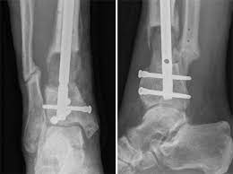Masquelet technique, which is the use of a temporary cement spacer followed by staged bone grafting, is a recent treatment strategy to manage a posttraumatic bone defect. Die Masquelet Technik Zur Behandlung Grosser Dia Und Metaphysarer Knochendefekte Springerlink