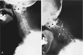 Image result for Ballottable Patella Sign