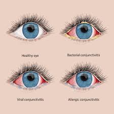 Image result for Allergic Conjunctivitis