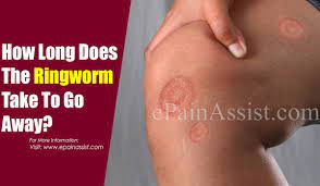 Creams, lotions, or powders don't work for ringworm on the scalp. How Long Does It Take For Ringworm To Go Away How To Prevent The Ringworm From Spreading