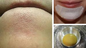Maybe you would like to learn more about one of these? How To Remove Whiteheads From Chin Kobo Guide