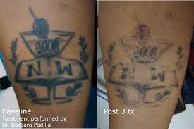 See reviews, photos, directions, phone numbers and more for the best tattoo removal in waterbury, ct. Laser Tattoo Removal Enlighten Latest And Most Effective Technology Fastest Results Hartford Ct