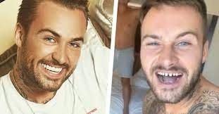 Mocht je je afvragen hoe dave's tanden er op dit moment uitzien, zonder facings. Dit Is Waarom Je Geen Neppe Tanden Moet Nemen Tandarts Geeft Uitleg Video