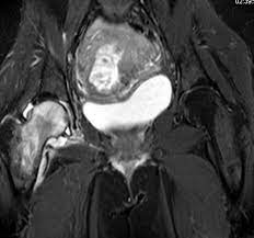 Transient Bone Marrow Oedema Of The Hip Mri Sumer S Radiology Blog