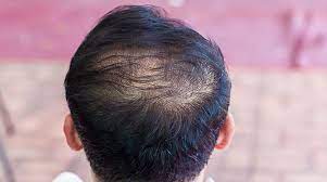 Our experts researched the different shampoos, foams, and oils to find the best hair loss treatments for best budget: Best Treatments For Thinning Hair For Men And Women Venus Treatments