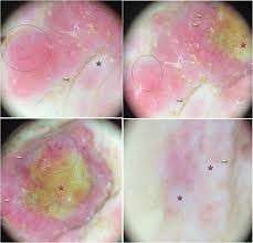 A helpful clue is the appearance of a darker section on one edge or a. Dermoscopy Of Skin Metastases From Breast Cancer Two Case Reports Journal Of Medical Case Reports Full Text