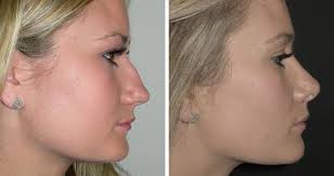 How Much Does A Nose Job Cost In India Job Retro
