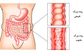 بیماری التهابی روده چیست؟ 10 نکته مهم با دکتر حسین یوسف فام