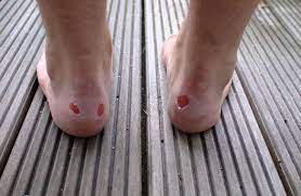 Faites bouillir de l'eau puis laissez infuser 3 sachets de thé. Comment Soigner Une Ampoule Au Pied Guide Astuces