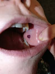 Maybe you would like to learn more about one of these? Blood Blister On My Cheek What Should I Do With It Popping